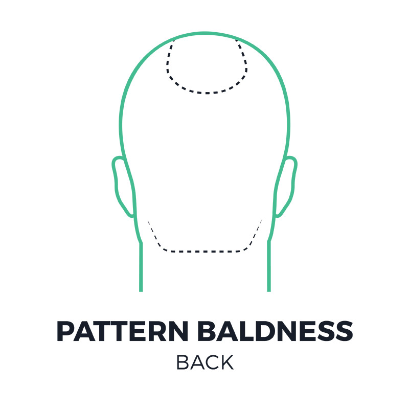 smp-pattern-baldness-back-smpflorida