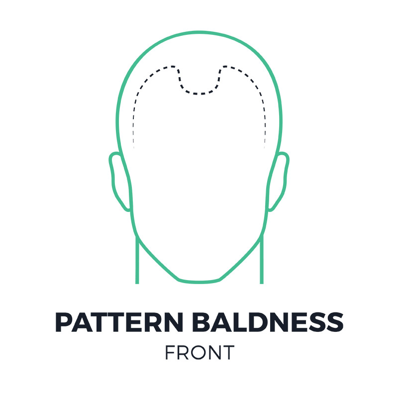 smp-pattern-baldness-front-smpflorida